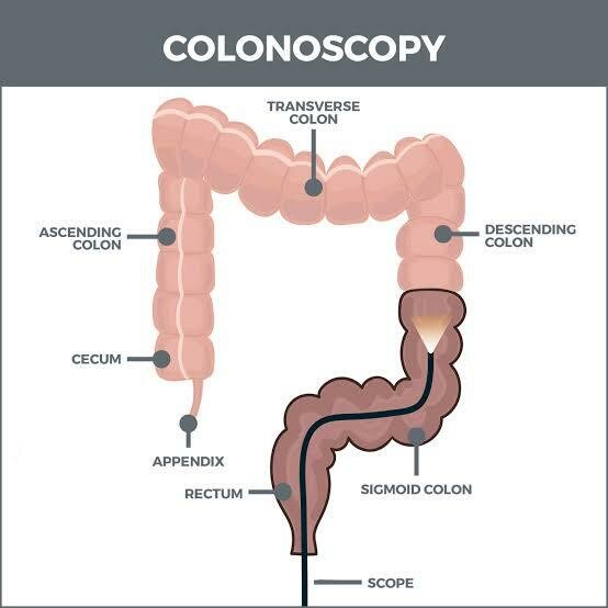 Understanding Colonoscopy