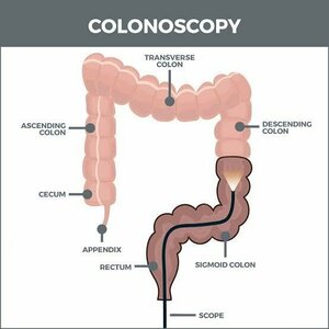 Understanding Colonoscopy by Dr. Varun Khandagale