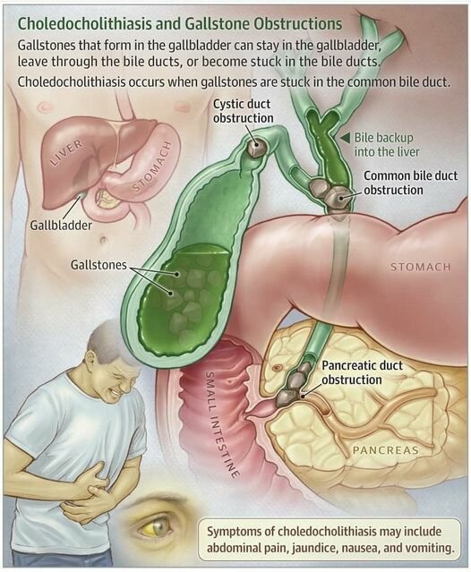 Potholes in the gallbladder Diagnosis and precaution | Dr. Varun Khandagale